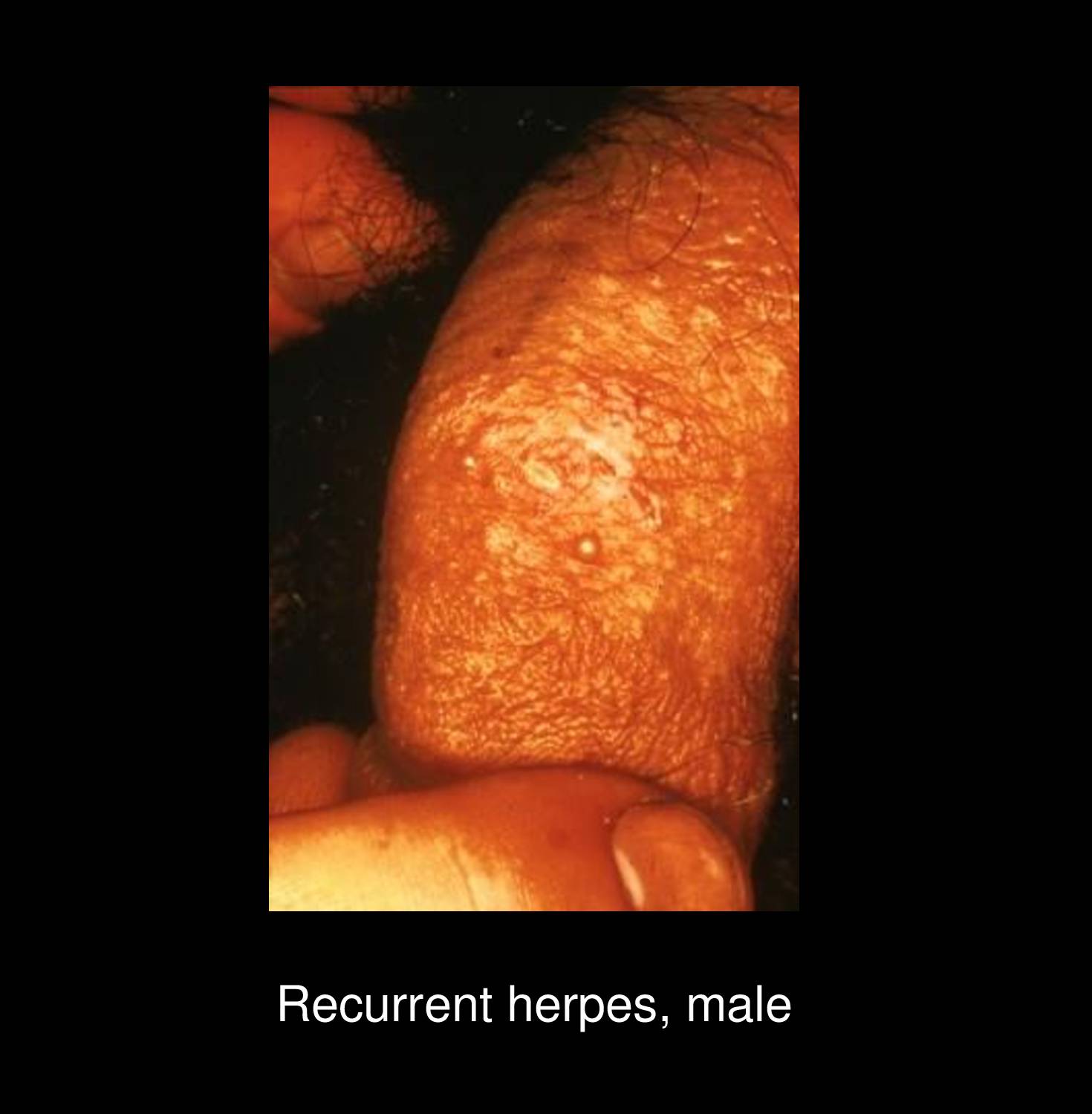 Herpes simplex virus infection with ruptured vesicles forming painful erosions and ulcerations on perineal region in recurrent outbreak